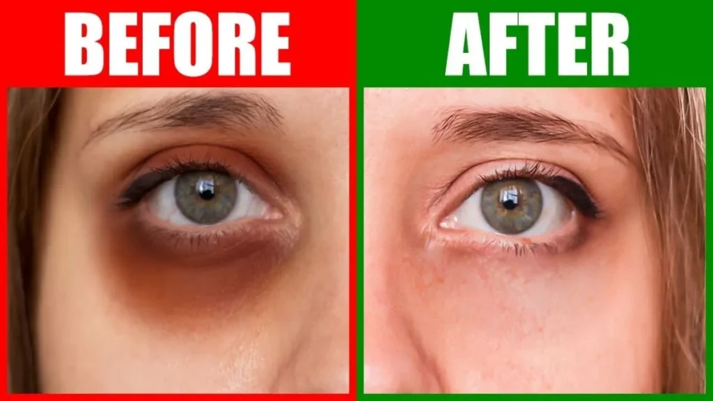 Dark Circles Under Eyes