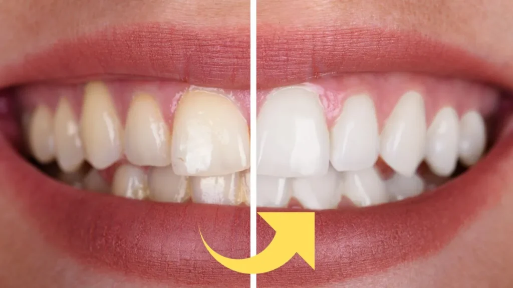 Rid Of Yellow Teeth